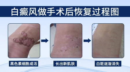 手术移植治疗白癜风还会复发吗