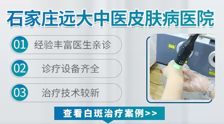 白癜风喝中药能治好吗