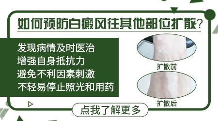 如何避免白癜风长到其他位置