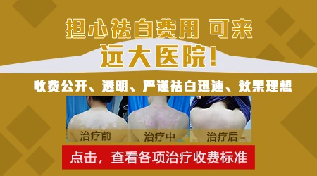 白癜风做激光一次要多少钱