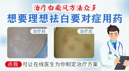 河北治疗白癜风的方法都有哪些