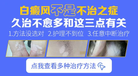 白斑用什么药膏最有效