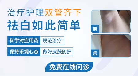 白斑边缘变得模糊变大了怎么办