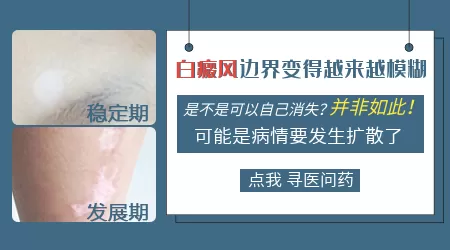 白斑边缘变得模糊变大了怎么办