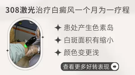 308照白癜风的原理是什么