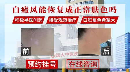 白癜风可以恢复吗