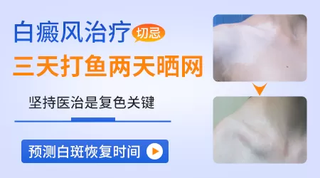 白癜风可以恢复吗