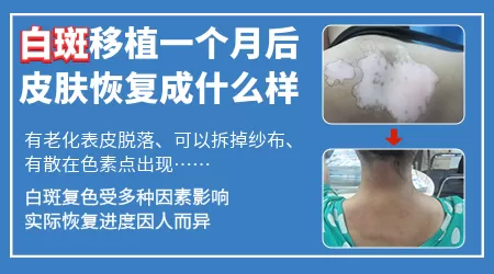 黑色素移植手术多久能复色