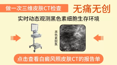 wood灯检查荧光强度和白斑严重程度相关吗