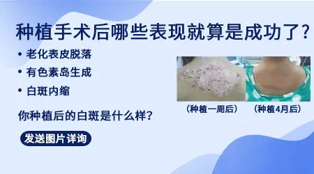 手术治疗白癜风成功率有多高