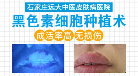 黑色素种植手术的成功率是多少