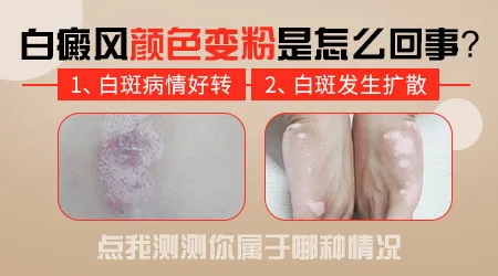 白癜风周围变粉红色是好转吗
