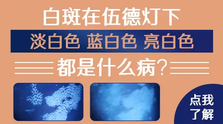 wood灯下发蓝白色荧光就一定是白癜风吗