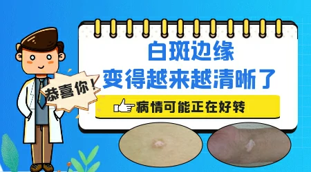 皮肤白块边缘越来越清楚好事还是坏事