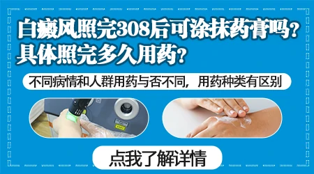白癜风用药期间可以照308激光吗 间隔多久比较好