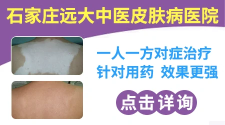 白癜风好转过程图 恢复过程有什么表现