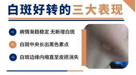 白癜风好转过程图 恢复过程有什么表现