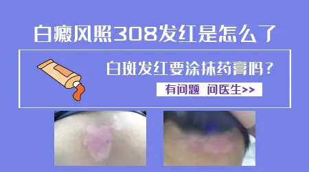 白癜风打308激光后变红变黑怎么回事