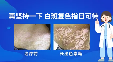 白斑周围出现色素加深环是好转信号吗