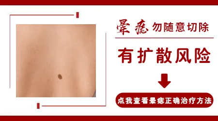 晕痣型白癜风点痣后能不能自愈