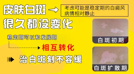 手背白斑几年没变化还要治疗吗