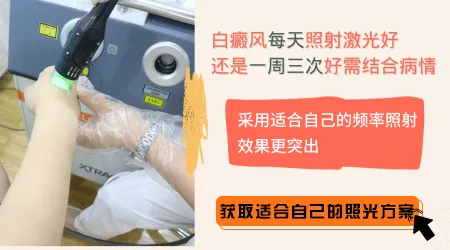 白癜风初期做光疗要多久一次