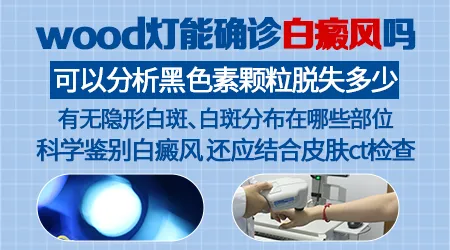 伍德灯没能确诊白斑怎么办