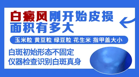 怎么测量白癜风的白斑面积 有什么标准