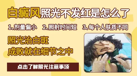 白癜风照308光后没反应不红还要照吗