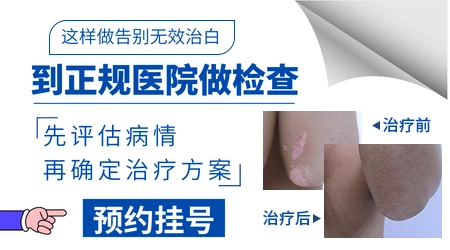 白癜风停药就复发怎么办