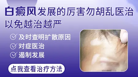 白癜风进入发展期怎么办