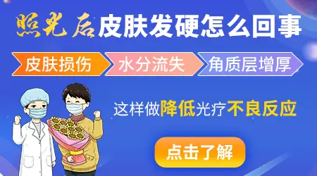 窄谱UVB治疗多年白癜风有用吗