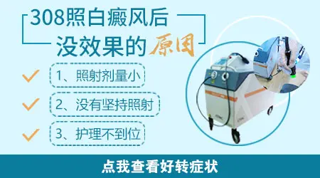 白癜风光疗几个月后白斑没变化是不是该放弃