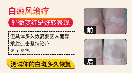 白斑开始变红是要好了吗