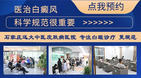 白癜风吃药多久能控制住不扩散