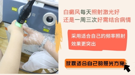 光疗治白癜风每周做几次效果最好