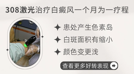 308激光治疗白癜风一个疗程是多久