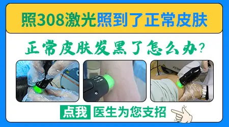 白癜风照308激光正常皮肤被照黑能恢复吗