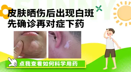 皮肤晒伤后出现白斑擦什么药效果好