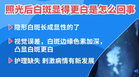 白癜风照光感觉越照越白是什么情况