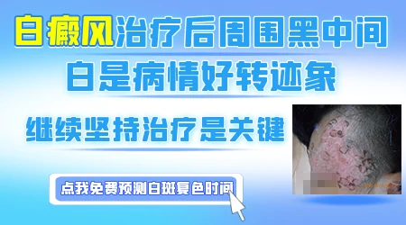 308激光治疗后白斑周围发黑正常吗