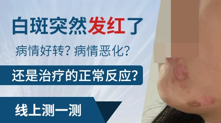 白癜风的白斑处发红发痒到底是好转还是加重
