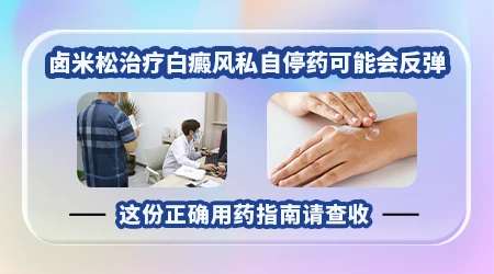 白癜风用卤米松多久就要停药