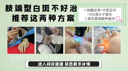 为什么脸上的白癜风好得快手脚上的却好得慢