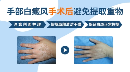 为什么脸上的白癜风好得快手脚上的却好得慢