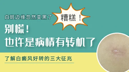 白癜风种植后白斑边缘发黑是好转了吗