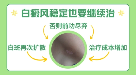 伍德灯检查能看出白斑处于什么阶段吗