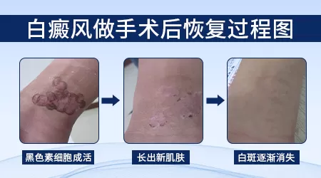 邯郸哪家医院做白癜风移植手术好