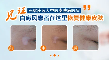 邯郸哪个医生治白癜风有名