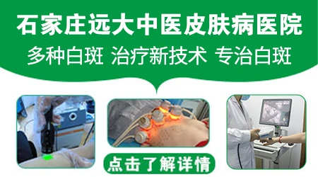 邯郸哪家医院治疗白斑最好